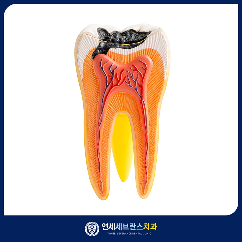 인레이 온레이 충치치료 이미지