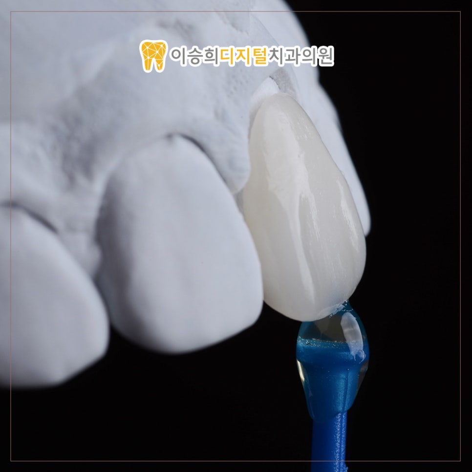 Read more about the article 온천장미니쉬를 활용한 치아손상 최소화 전략