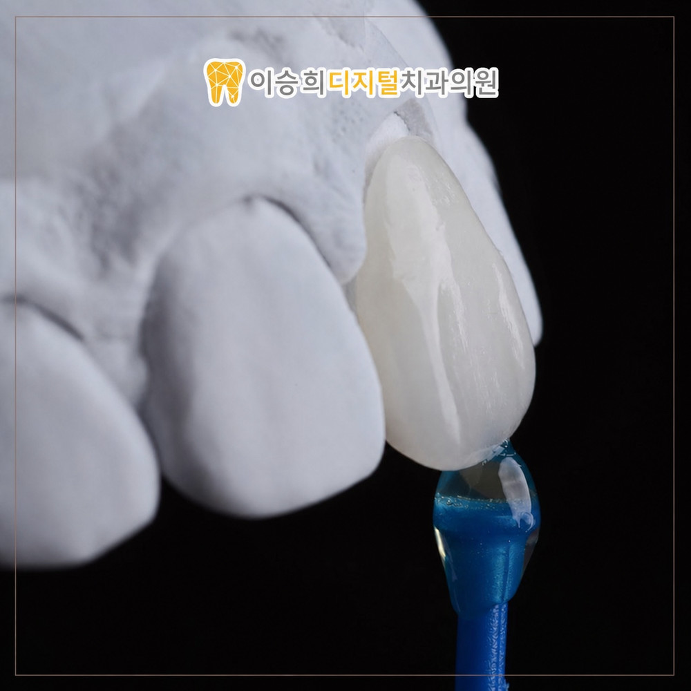 Read more about the article 온천장미니쉬, 치아 손상을 줄이는 방법으로