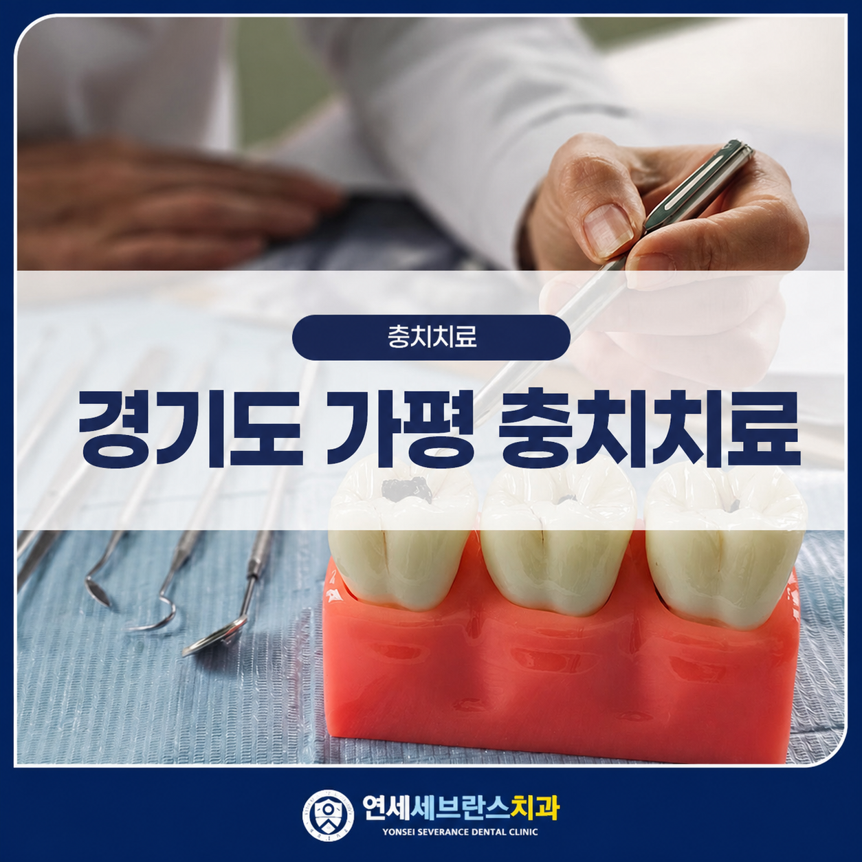 충치치료 설명 이미지