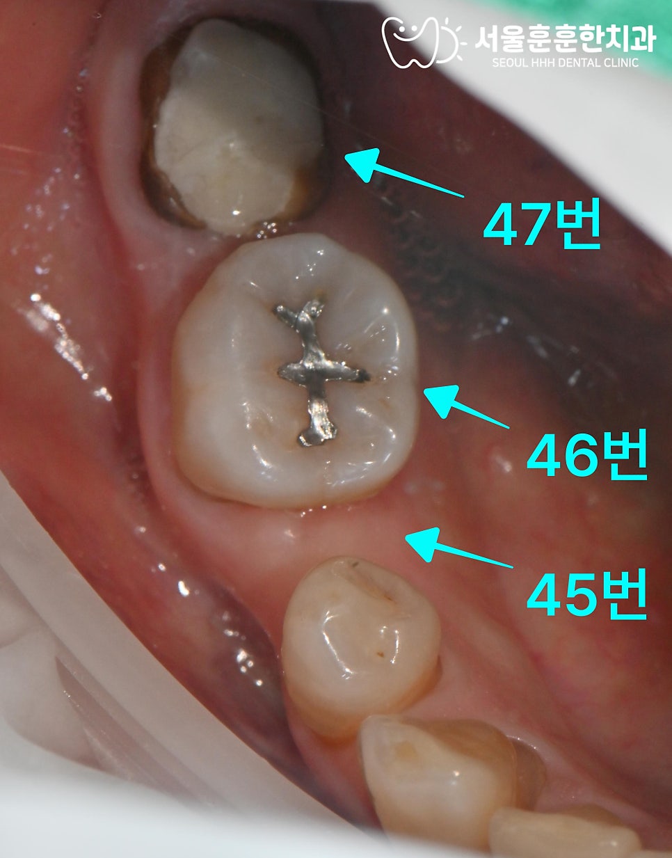골다공증약임플란트치료