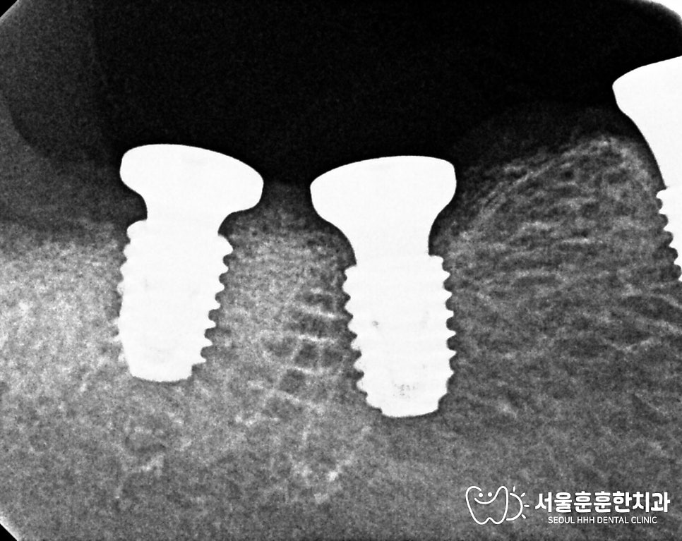 임플란트전골다공증확인