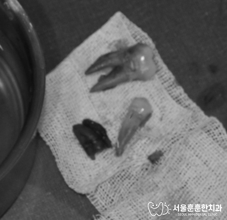 장기투여임플란트주의점