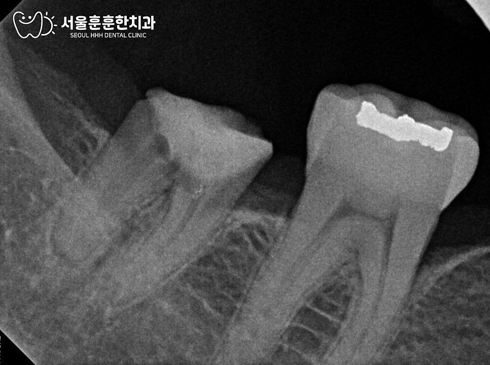 프롤리아주사임플란트