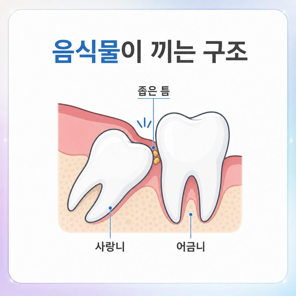 서울치과 일부만 나온 사랑니와 잇몸 덮임으로 칫솔 접근 어려운 음식물 끼임