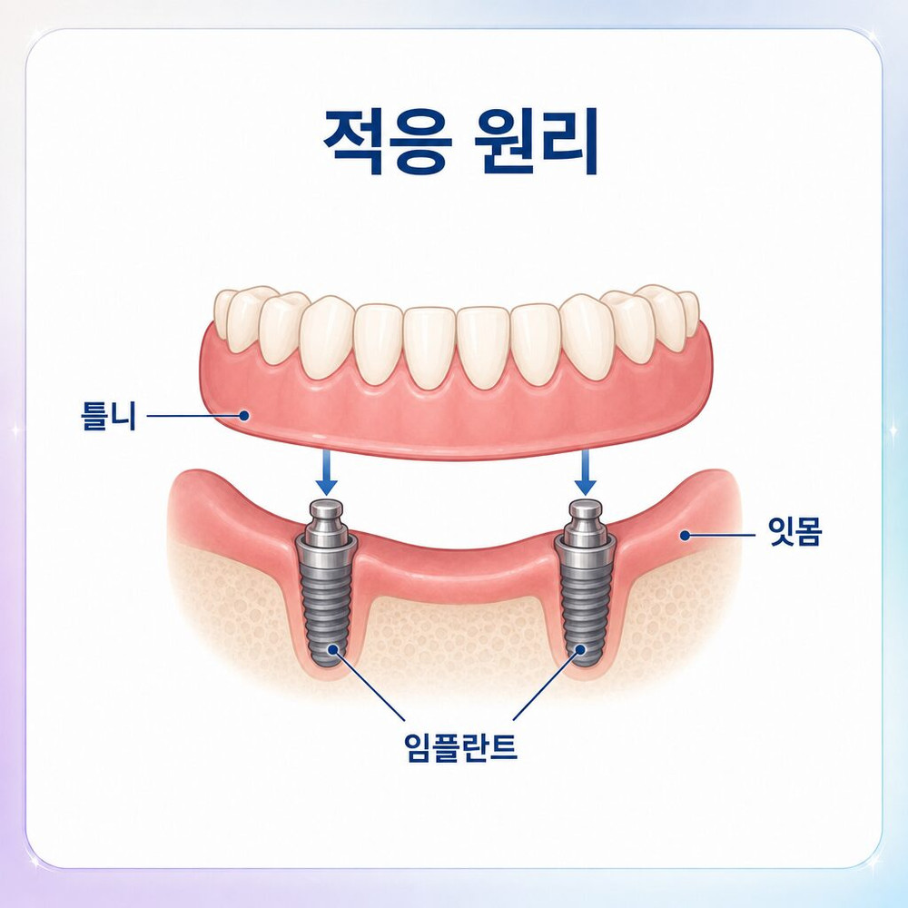 서울치과 상담 전 부드럽고 작은 음식으로 시작하는 부모님 식사 적응 방법