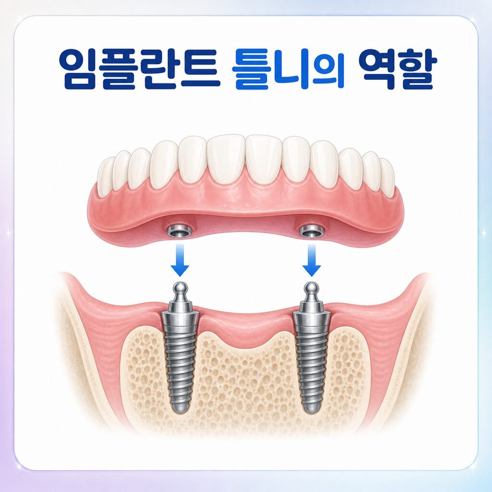 서울치과 임플란트 틀니 초기 통증과 헐림 지켜볼 불편과 진료 필요 신호