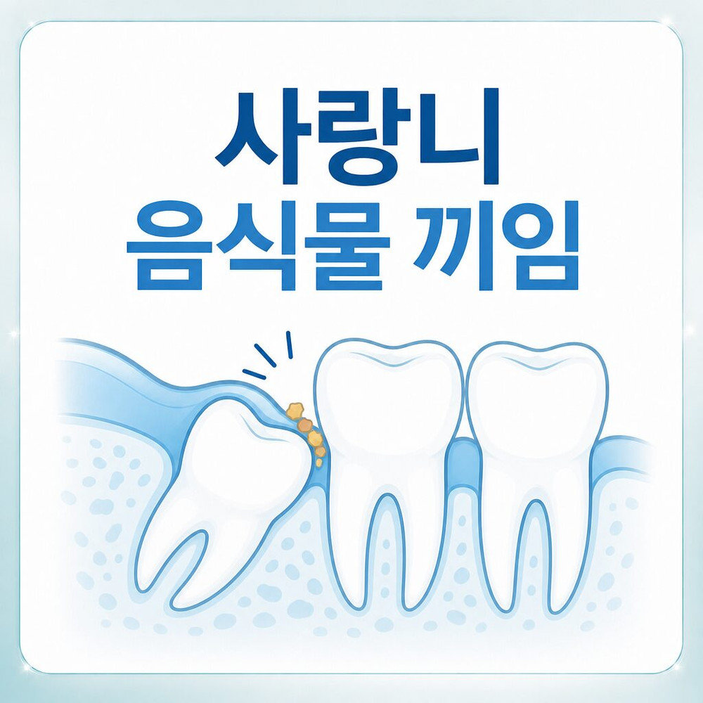 Read more about the article 서울치과 사랑니발치, 통증 없이 음식물이 자주 끼는 이유