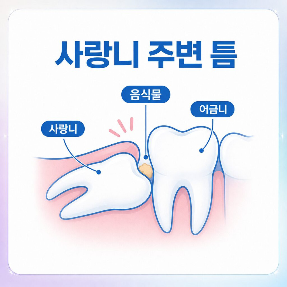 서울치과 사랑니 비스듬한 위치와 잇몸 덮임 좁은 틈 음식물 저장 공간 형성 주요한 원인