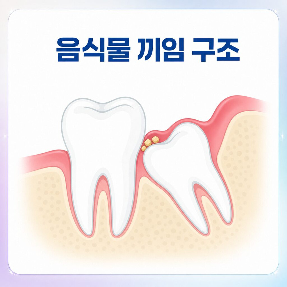 서울치과 사랑니발치 후 발치 공간 형태와 반복 음식물 고임의 의미와 관리 기준
